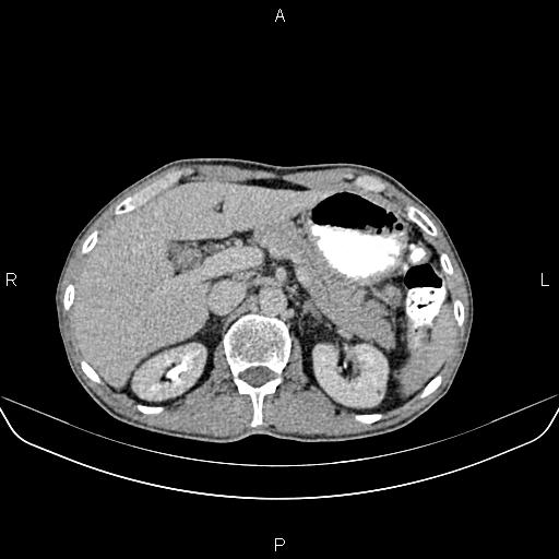 File:Colon adenocarcinoma - hepatic flexure (Radiopaedia 85635-101395 Axial C+ delayed 26).jpg