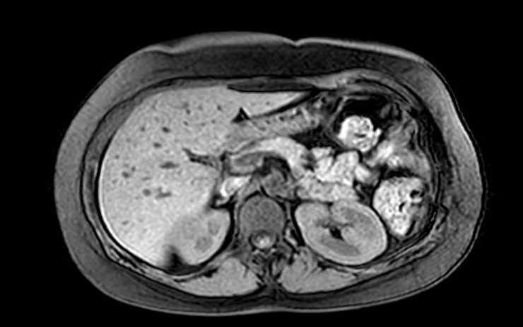 Colon adenocarcinoma with Krukenberg tumors, advanced pregnancy (Radiopaedia 67279-76645 A 59).jpg