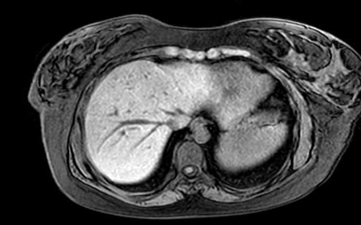 Colon adenocarcinoma with Krukenberg tumors, advanced pregnancy (Radiopaedia 67279-76645 A 74).jpg