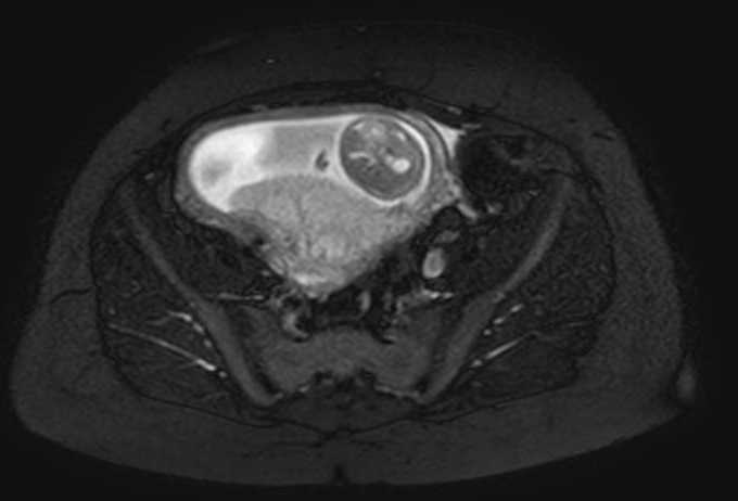 Colon adenocarcinoma with Krukenberg tumors, advanced pregnancy (Radiopaedia 67279-76645 Axial T2 SPAIR 21).jpg