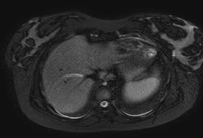 Colon adenocarcinoma with Krukenberg tumors, advanced pregnancy (Radiopaedia 67279-76645 Axial T2 SPAIR 77).jpg