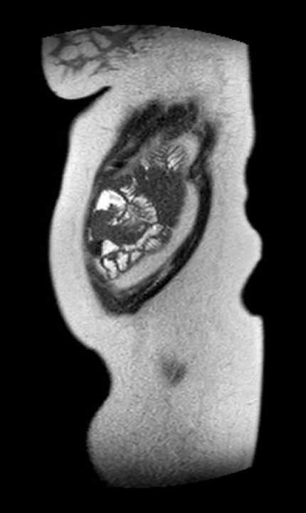 Colon adenocarcinoma with Krukenberg tumors, advanced pregnancy (Radiopaedia 67279-76645 Sagittal T2 4).jpg