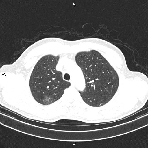 File:Colon cancer (Radiopaedia 85663-101443 Axial lung window 17).jpg
