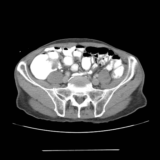 File:Colon cancer with calcified liver metastasis (Radiopaedia 74423-85307 A 55).jpg