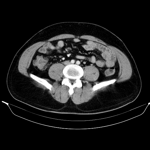 Colonic lipoma with colo-colic intussusception (Radiopaedia 58944-66200 A 41).jpg