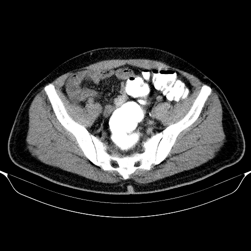 File:Colonic lipoma with colo-colic intussusception (Radiopaedia 58944-66200 Axial C+ rectal 57).jpg