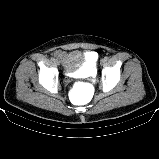Colonic lipoma with colo-colic intussusception (Radiopaedia 58944-66200 Axial C+ rectal 65).jpg