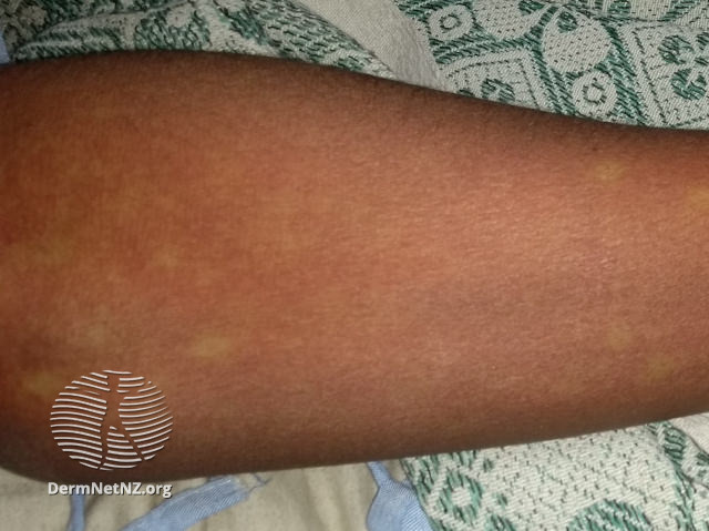 File:Dengue rash (DermNet NZ dengue-rash-01).jpg