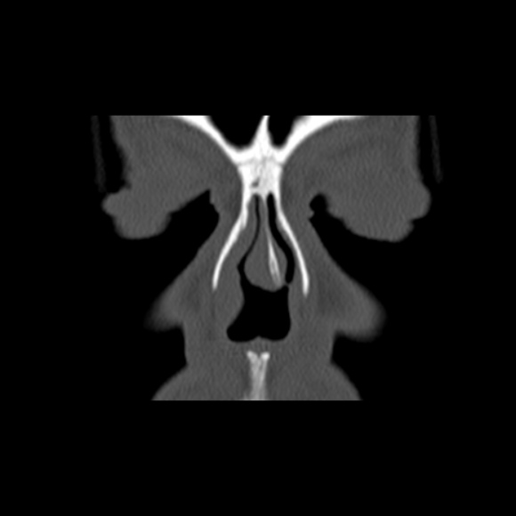 Nasal septal perforation (Radiopaedia 25030-25289 Coronal bone window 12).jpg