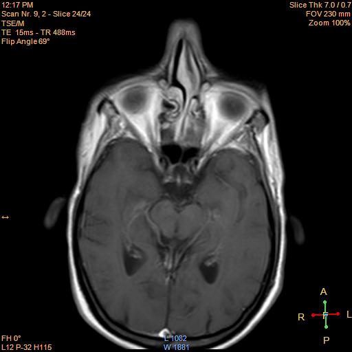 File:Nasopharyngeal carcinoma (Radiopaedia 22375-22403 Axial T1 C+ 1).jpg