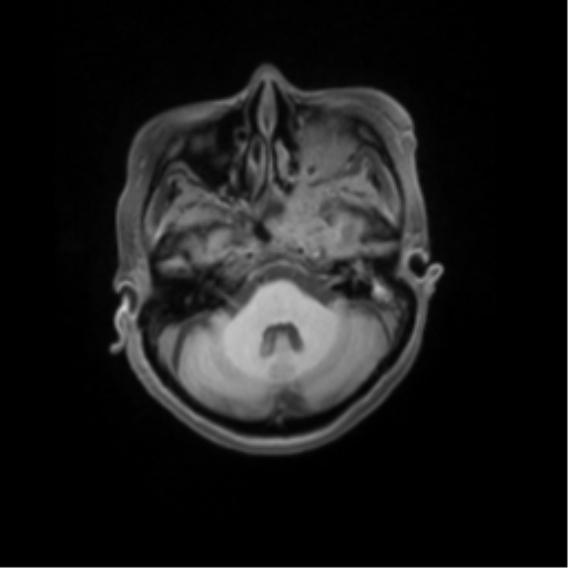 File:Nasopharyngeal carcinoma with cerebral abscess (Radiopaedia 43018-46274 Axial T1 fat sat 15).png