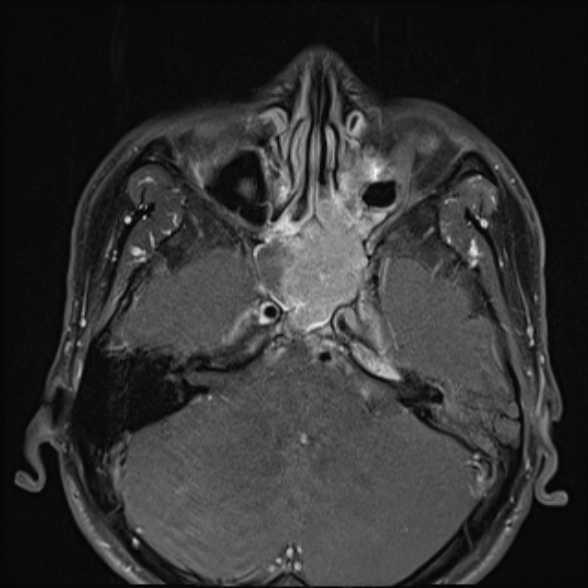 Nasopharyngeal carcinoma with skull base invasion (Radiopaedia 53415-59485 Axial T1 C+ fat sat 20).jpg