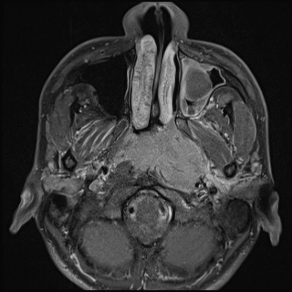 Nasopharyngeal carcinoma with skull base invasion (Radiopaedia 53415-59485 Axial T1 C+ fat sat 28).jpg