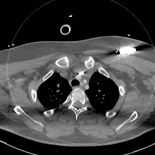 Neck CT angiogram (intraosseous vascular access) (Radiopaedia 55481-61945 B 73).jpg
