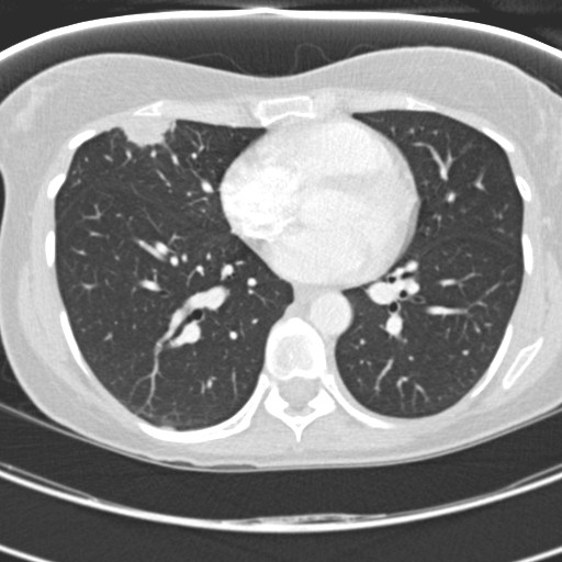 File:Necrobiotic pulmonary nodules - Crohn disease (Radiopaedia 20723-20631 Axial lung window 86).jpg