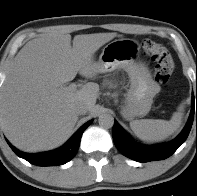 File:Necrotizing pancreatitis with acute necrotic collection (Radiopaedia 14470-14417 Axial non-contrast 4).jpg