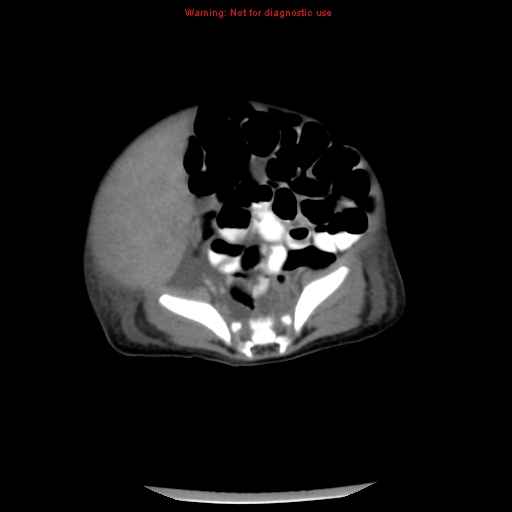 File:Neonatal neuroblastoma (Radiopaedia 9564-10223 A 39).jpg