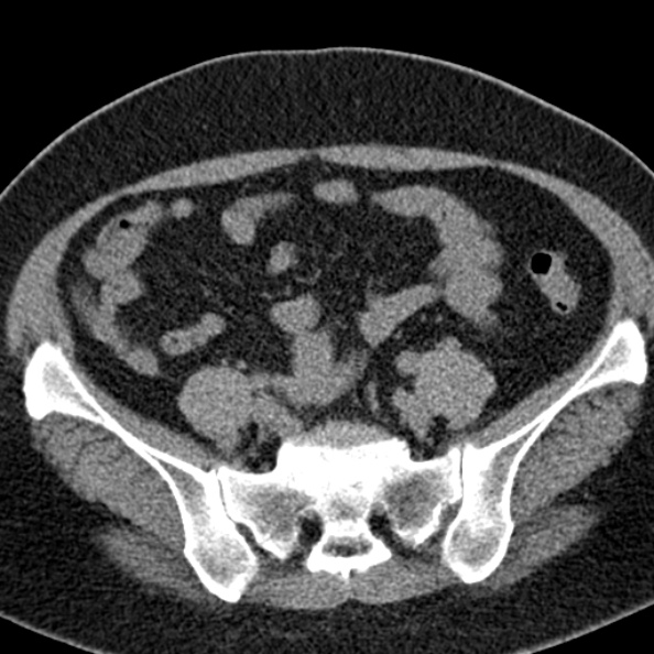 File:Nephrostomy for urosepsis (Radiopaedia 26180-26330 Axial non-contrast 46).jpg