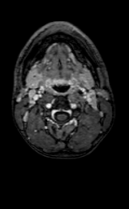 Neuro-Behçet disease (Radiopaedia 90112-107294 Axial T1 C+ 247).jpg