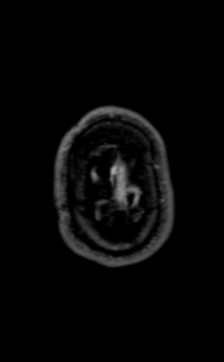 Neuro-Behçet disease (Radiopaedia 90112-107294 Axial T1 C+ 54).jpg