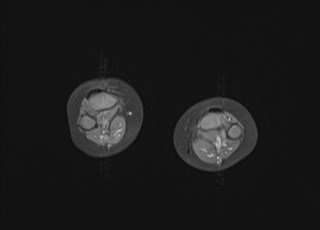 File:Neuroblastoma with bone metastases (Radiopaedia 67080-76414 Axial T1 C+ fat sat 1).jpg