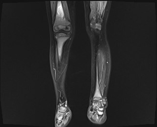 File:Neuroblastoma with bone metastases (Radiopaedia 67080-76414 B 5).jpg