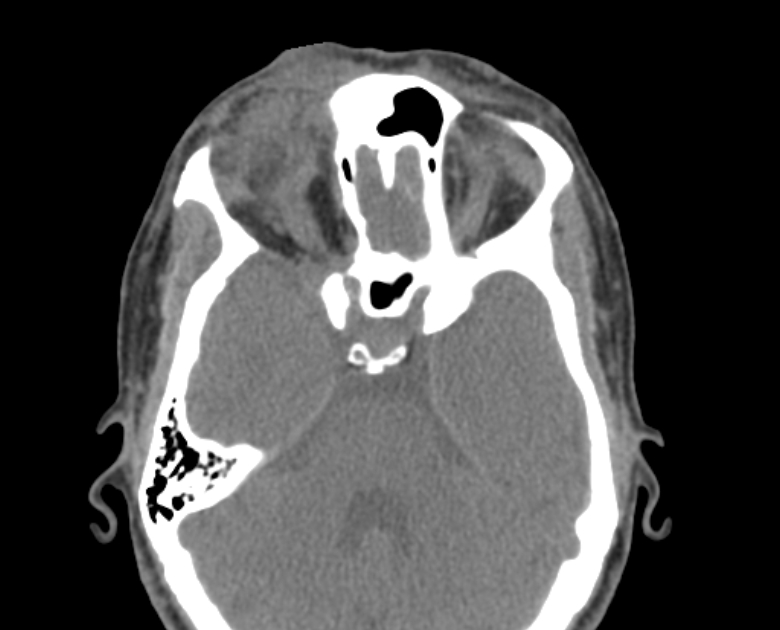 Neurofibromatosis type 1- orbital manifestations (Radiopaedia 49391-54511 Axial non-contrast 56).jpg