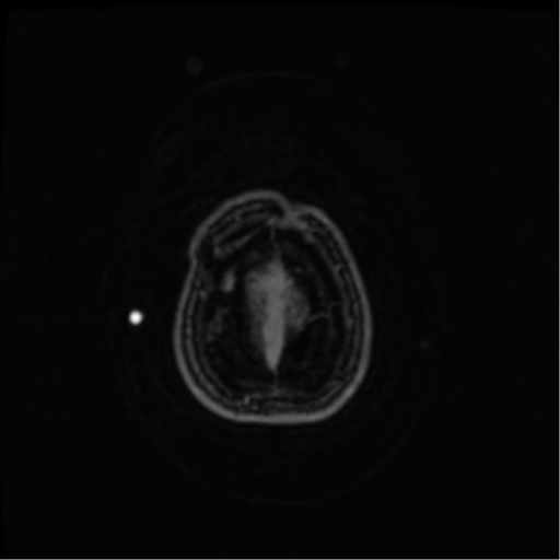 Neurofibromatosis type 2 (Radiopaedia 45229-49244 Axial T1 C+ 109).png
