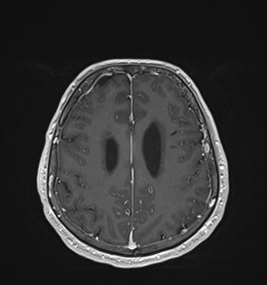 Neurofibromatosis type 2 (Radiopaedia 79097-92049 Axial T1 C+ 142).jpg