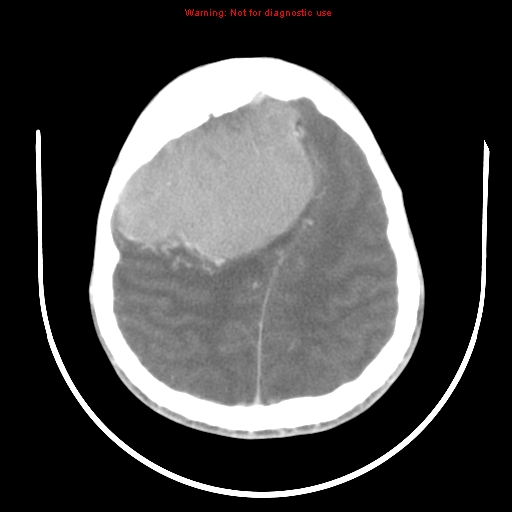 File:Neurofibromatosis type 2 (Radiopaedia 8953-9732 C 25).jpg