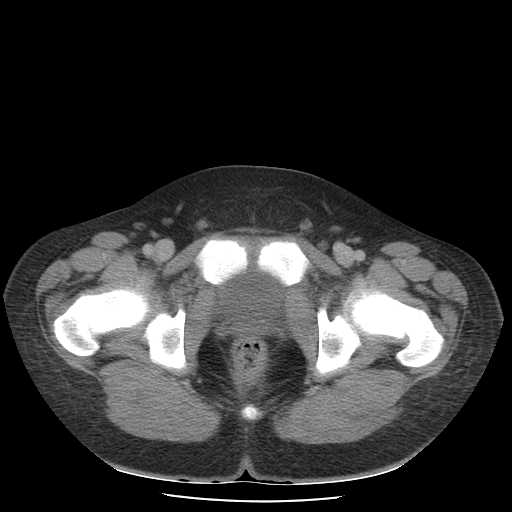 File:Non-Hodgkin lymphoma involving pelvis (Radiopaedia 21281-21197 A 61).jpg