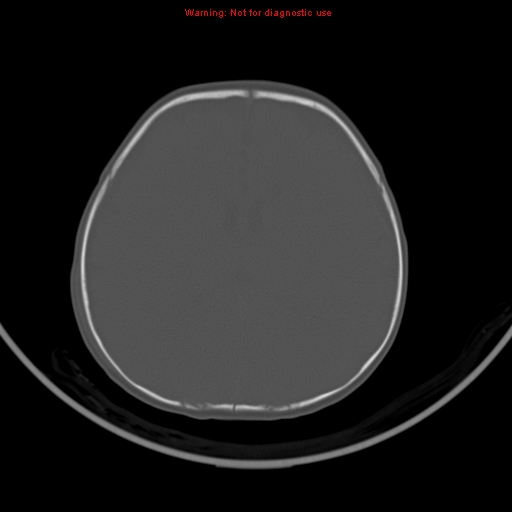 File:Non-accidental injury - bilateral subdural with acute blood (Radiopaedia 10236-10765 Axial bone window 14).jpg