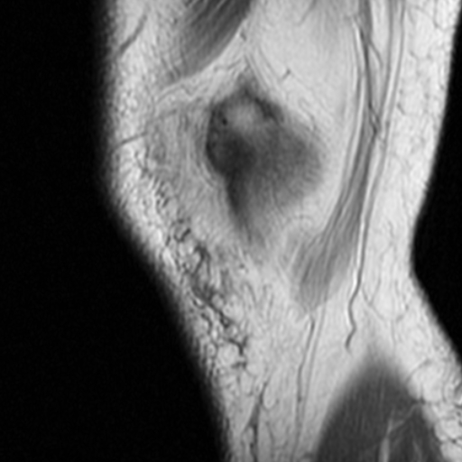 File:Non-displaced patella fracture (Radiopaedia 15932-15582 Sagittal T1 1).jpg