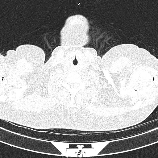 Non-specific interstitial pneumonia (Radiopaedia 83185-97567 Axial lung window 3).jpg