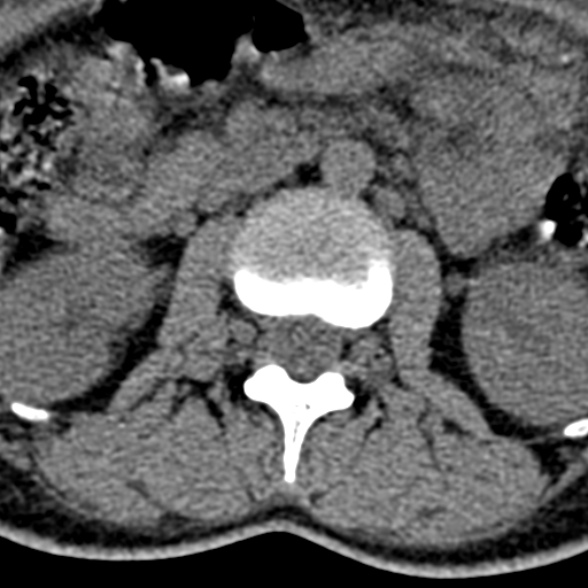 Normal CT lumbar spine (Radiopaedia 53981-60118 Axial non-contrast 37).jpg
