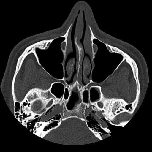Normal CT paranasal sinuses (Radiopaedia 42286-45390 Axial bone window 69).jpg