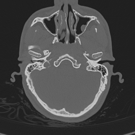 Normal CT skull (Radiopaedia 40798-43459 A 32).png