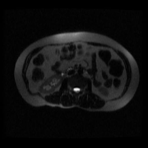 File:Normal MRCP (Radiopaedia 41966-44978 Axial T2 thins 1).png