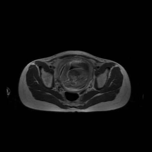 File:Normal MRI abdomen in pregnancy (Radiopaedia 88001-104541 Axial T2 61).jpg