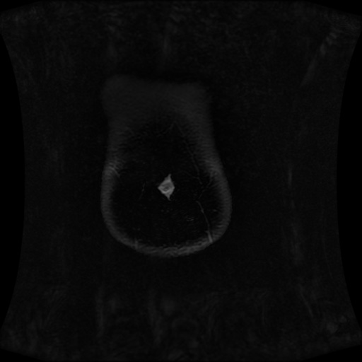 Normal MRI abdomen in pregnancy (Radiopaedia 88001-104541 M 15).jpg