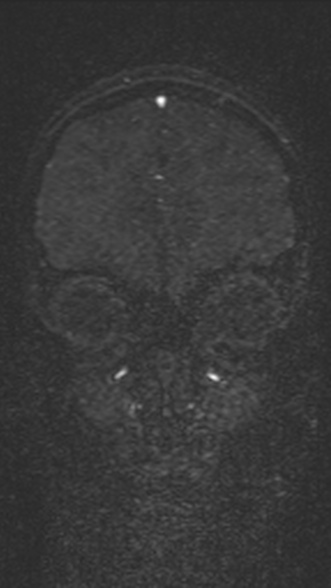 Normal MRI brain with MRV- teenager (Radiopaedia 49425-54553 Coronal MRV 62).jpg