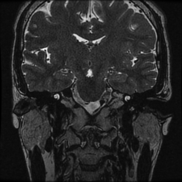 Normal MRI petrous (Radiopaedia 91317-108949 Coronal T2 37).jpg