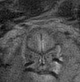 Normal brain fetal MRI - 22 weeks (Radiopaedia 50623-56050 Coronal T2 Haste 22).jpg