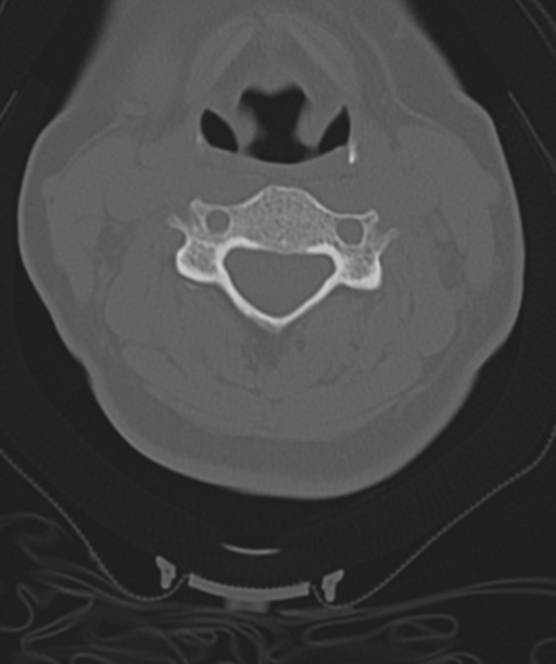 Normal cervical spine MRI (including Dixon) (Radiopaedia 42762-45926 Axial bone window 28).png