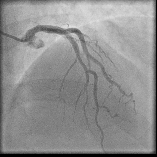 Normal coronary angiogram (DSA) (Radiopaedia 63081-71571 E 36).jpg