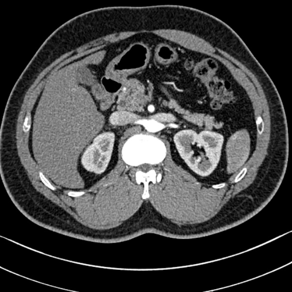 Normal kidneys on 4-phase CT study (Radiopaedia 25889-26038 B 22).jpg