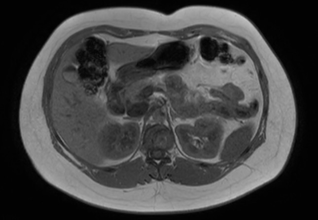 File:Normal liver MRI with Gadolinium (Radiopaedia 58913-66163 Axial T1 in-phase 18).jpg