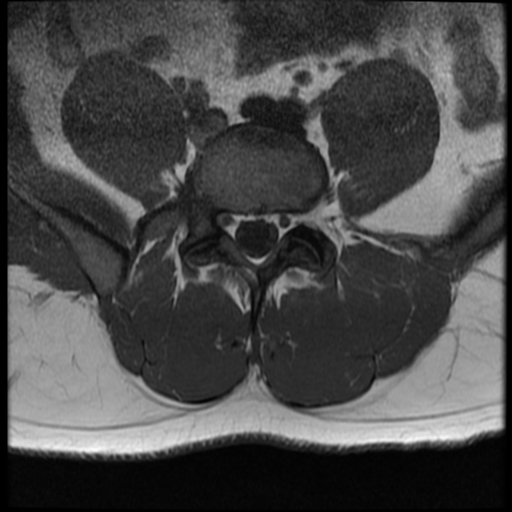 File:Normal lumbar spine MRI (Radiopaedia 35543-37039 Axial T1 12).png