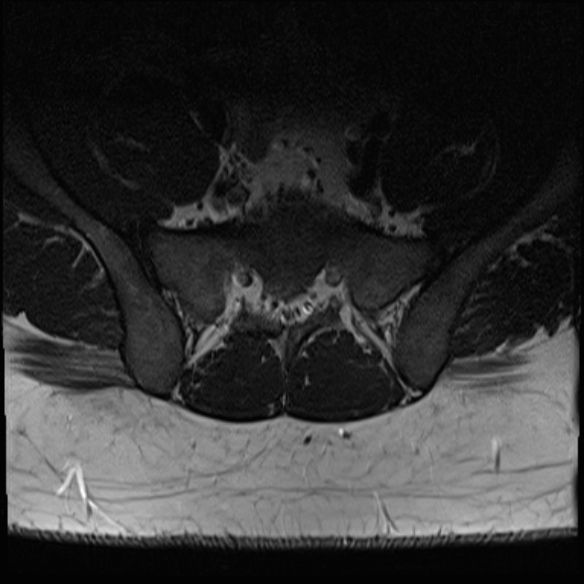 File:Normal lumbar spine MRI (Radiopaedia 47857-52609 Axial T2 33).jpg