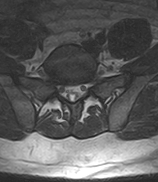 Normal lumbar spine MRI - low-field MRI scanner (Radiopaedia 40976-43699 Axial T2 88).jpg